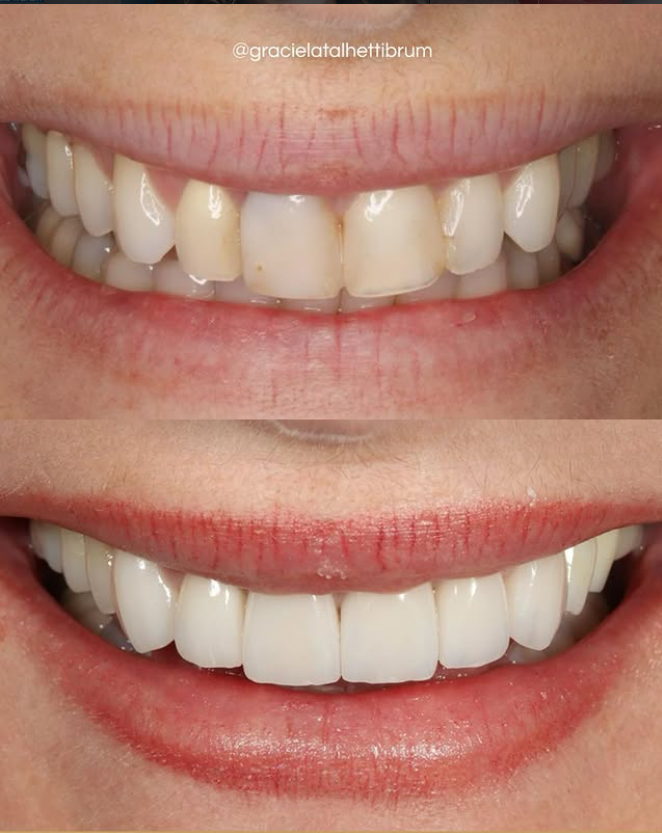Laminados Cerâmicos e Lentes de Contato Dental